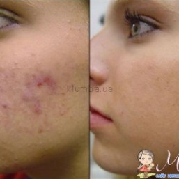 Победа над прыщами и черными точками.