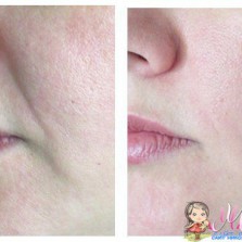 Массаж лица после уколов ботокса. 